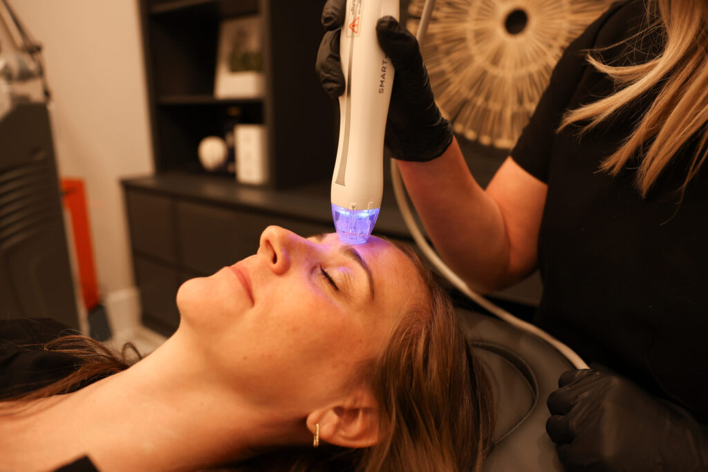RF Microneedling in Versailles, Ky