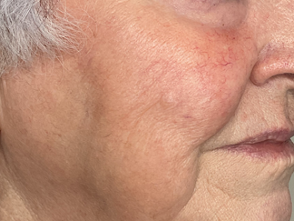 A woman after RF Microneedling Treatment at Mind and Body Medspa in Versailles, Kentucky