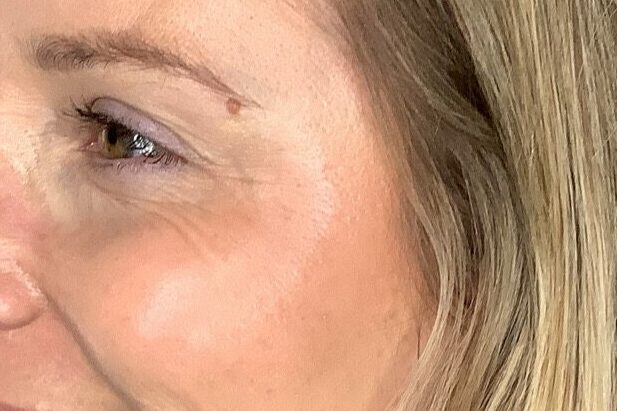 Woman after Dysport Injections for crows feet at mind and body medspa in Versailles, Kentucky