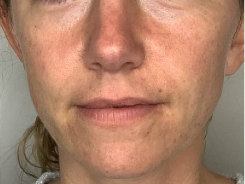 A woman's face before she receives her chemical peel