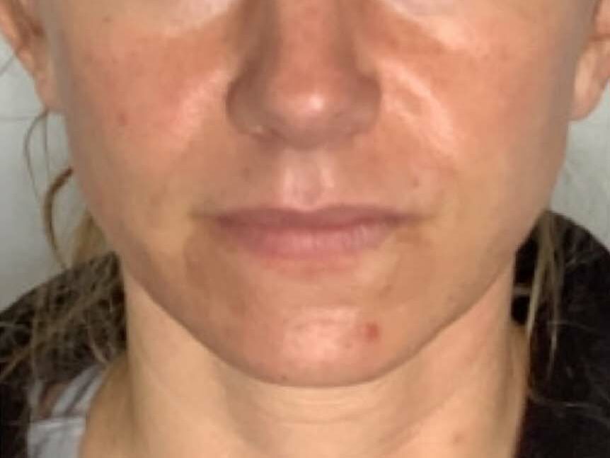 A woman's face after she has received her chemical peel