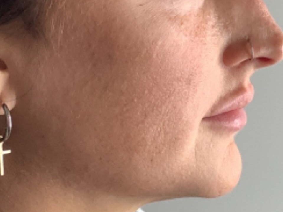 A woman's jawline before Mind and body's dermal fillers 