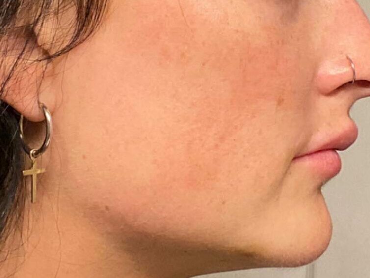 A woman's jawline after Mind and body's dermal fillers