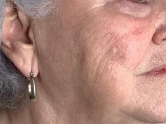 A woman before RF Microneedling Treatment at Mind and Body Medspa in Versailles, Kentucky