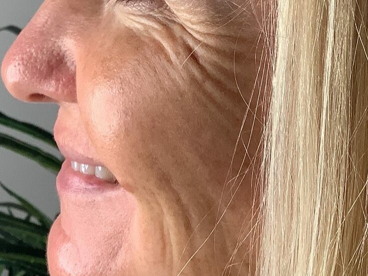 Before RF Microneedling  at Mind and Body Medspa in Versailles, Kentucky