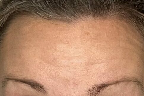 A woman before Botox injections at Mind and Body Medspa In Versailles, Kentucky