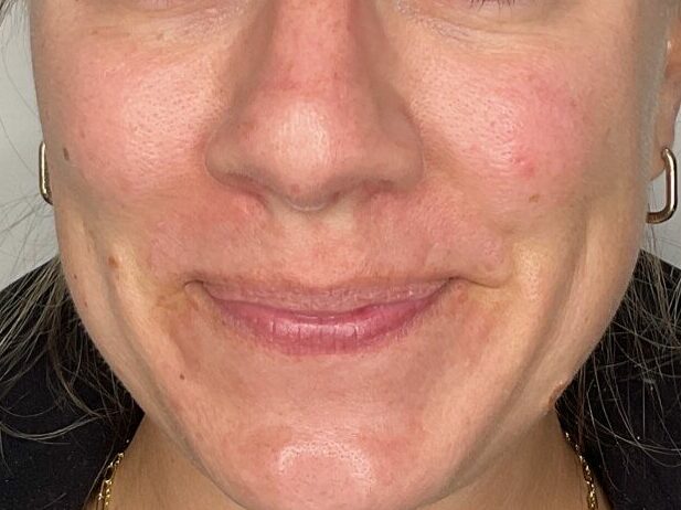 Mind and body medspa client after Hydrafacial 