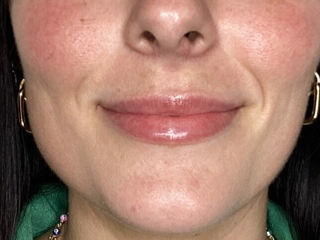 Restylane Dermal Fillers After Image 