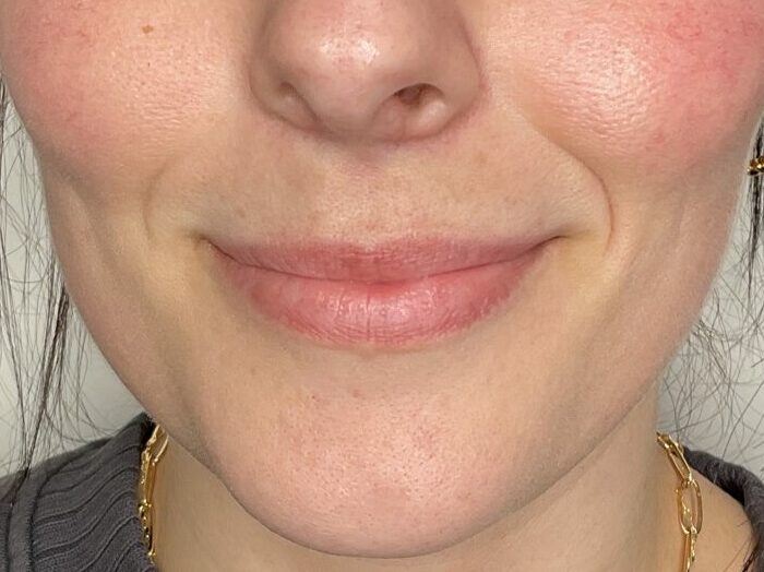 A woman before Restylane Dermal Fillers for her lips