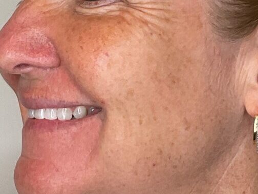 After RF Microneedling Treatment at Mind and Body Medspa in Versailles, Kentucky