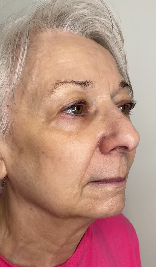 Microneedling After
